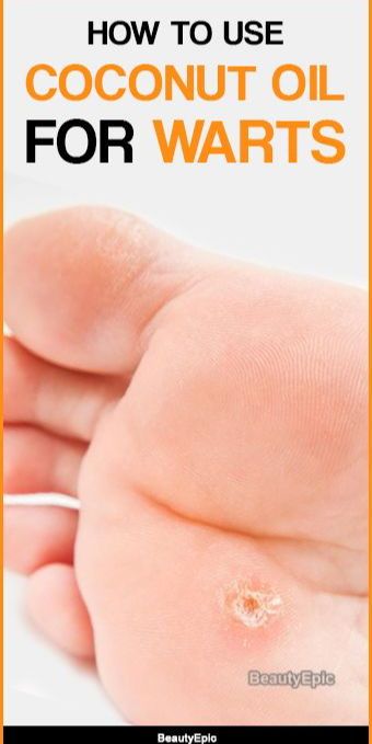 How Does Coconut Oil Get Rid of Warts