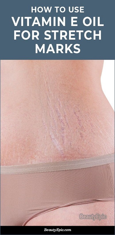 How to Use Vitamin E Oil to Remove Stretch Marks