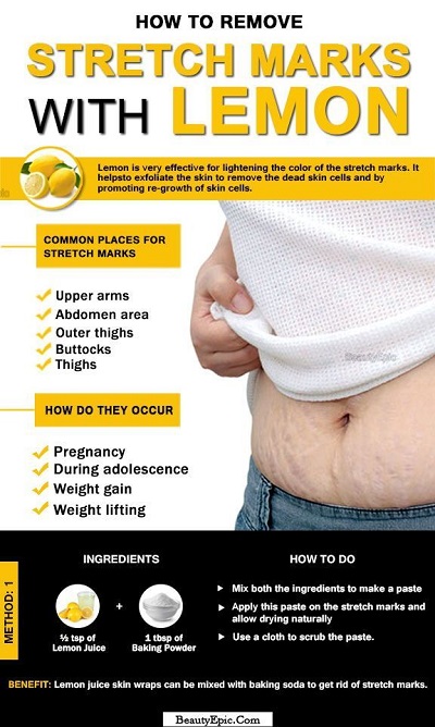 How To Remove Stretch Marks Fast With Lemon In 2025
