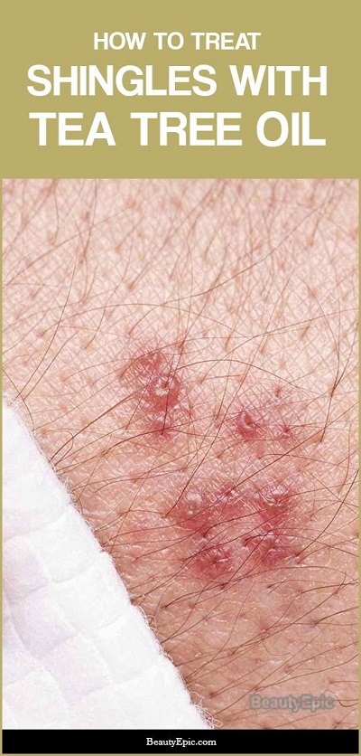 Is Tea Tree Oil Good For Shingles? How To Use It