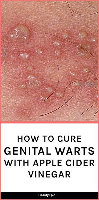 Apple Cider Vinegar For Genital Warts & How To Use It