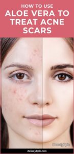 Aloe Vera For Acne Scars – Benefits And How To Use It