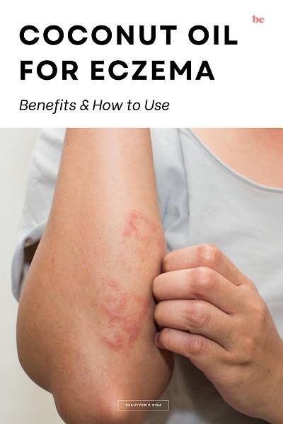 Coconut Oil for Eczema
