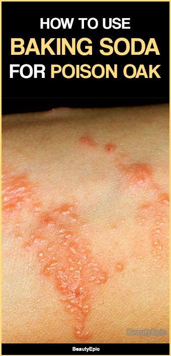 How To Use Baking Soda For Poison Oak