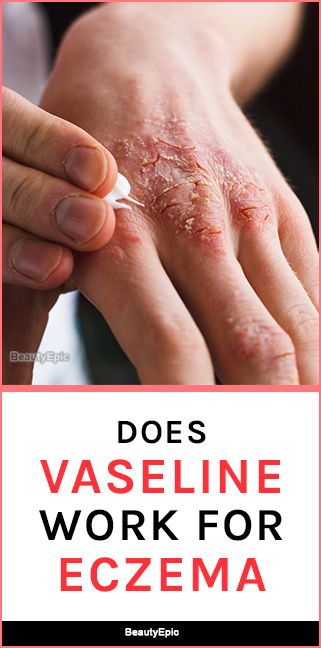 How To Use Vaseline For Eczema
