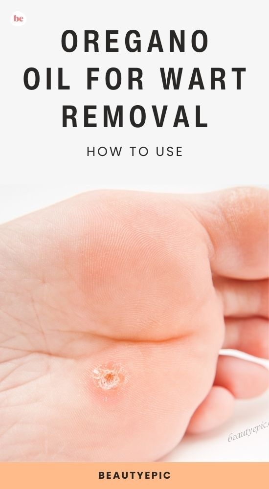 oregano oil for wart Removal