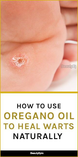 How To Use Oregano Oil For Warts In 2025