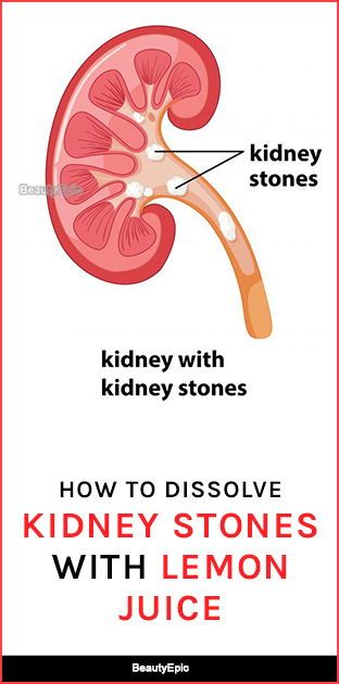 How To Dissolve Kidney Stones With Lemon Juice