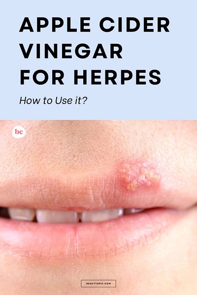 Apple Cider Vinegar for Herpes