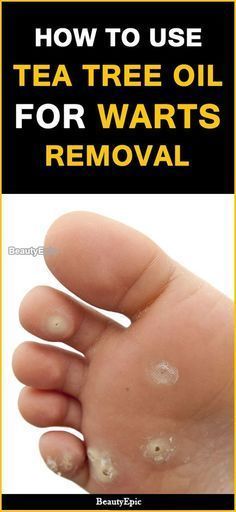 How To Remove Warts With Tea Tree Oil