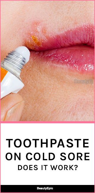 Does Toothpaste On Cold Sore Work