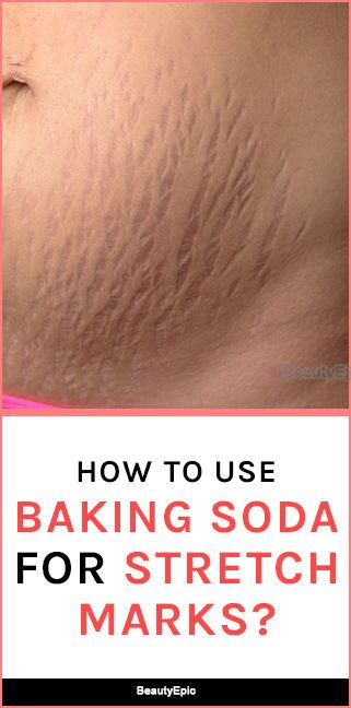 How To Use Baking Soda For Stretch Marks
