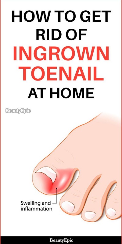 How to Get Rid of an Ingrown Toenail at Home