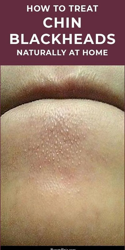 Blackheads on Chin