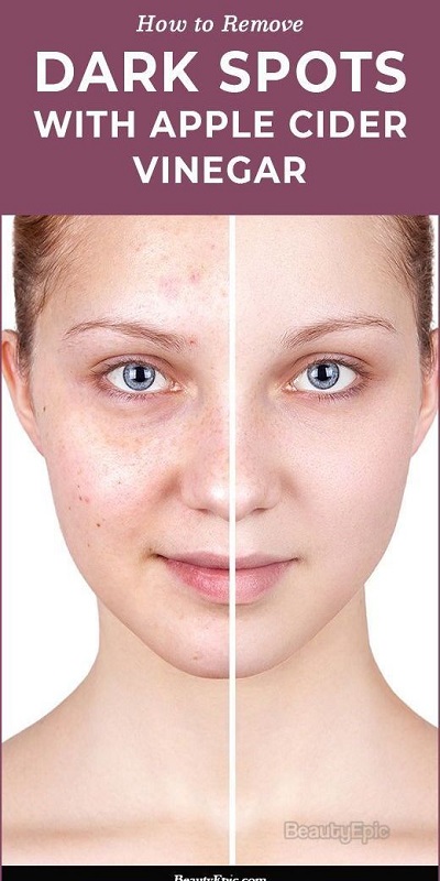 How to Remove Dark Spots with Apple Cider Vinegar
