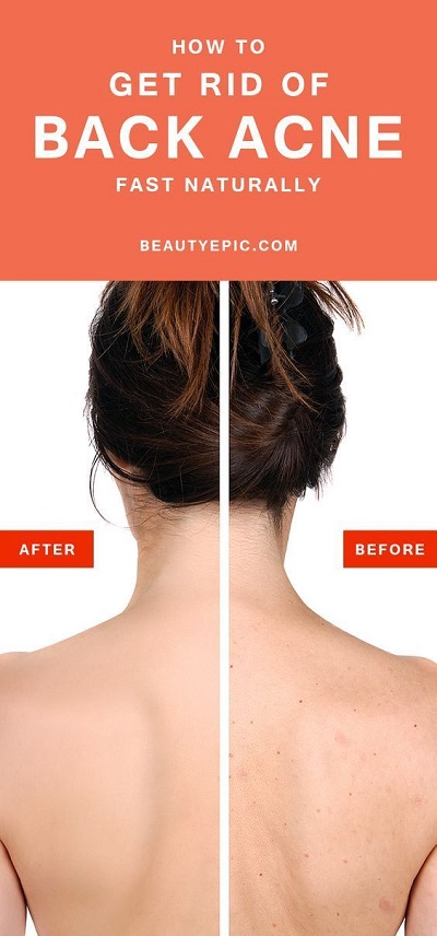 How To Get Rid Of Back Acne Fast Naturally