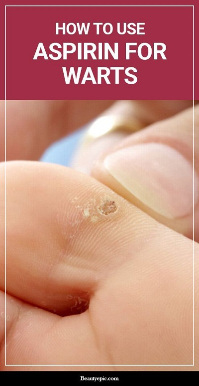 How to Use Aspirin to Treat a Warts