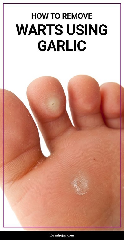 How to Remove Warts Naturally Using Garlic
