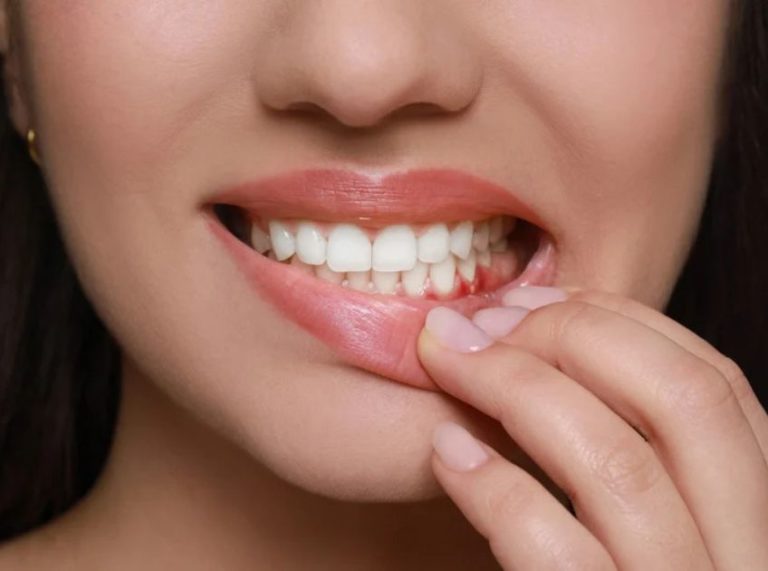 How to Treat Gum Disease at Home Causes & Home Remedies