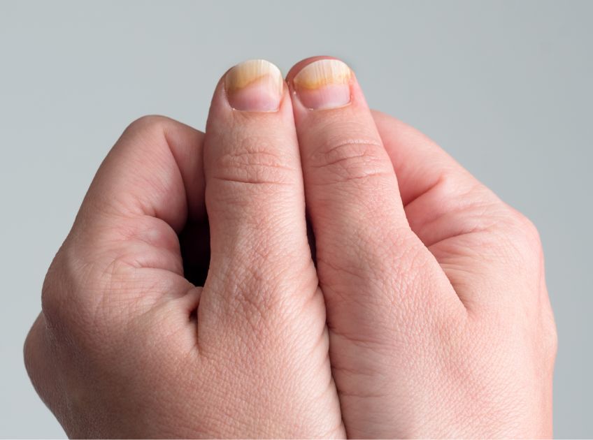 How to Get Rid of Yellow Nails at Home