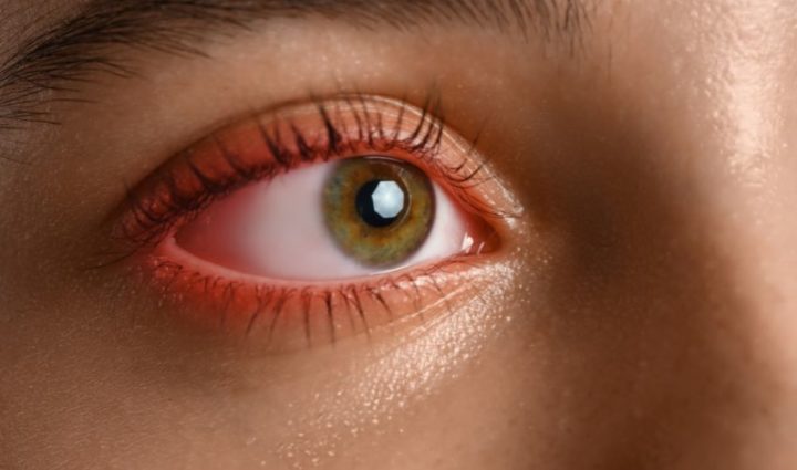 Redness and Swelling in The Eyes