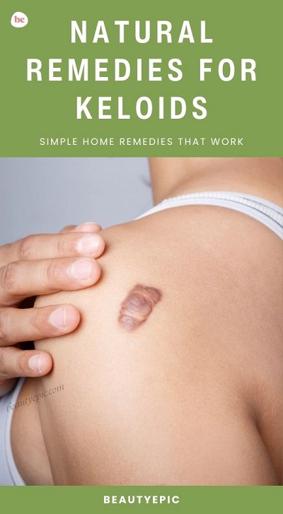 Natural Remedies For Keloids