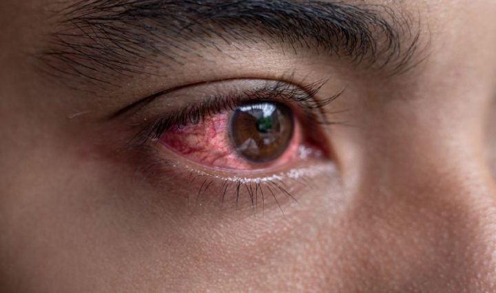 Eyes Turn Red While Crying