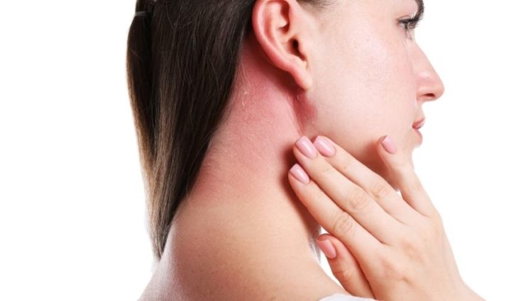 Get a Cure for Sunburn