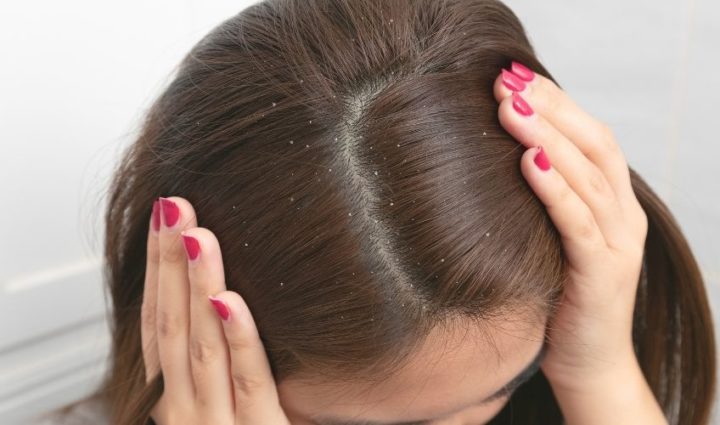 Helping to Control Dandruff