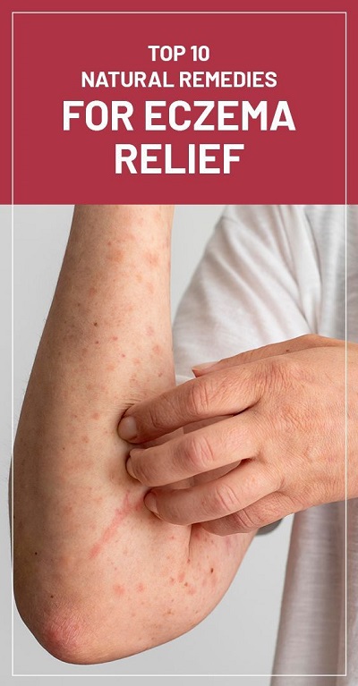 Top 10 Natural Remedies for Eczema Relief