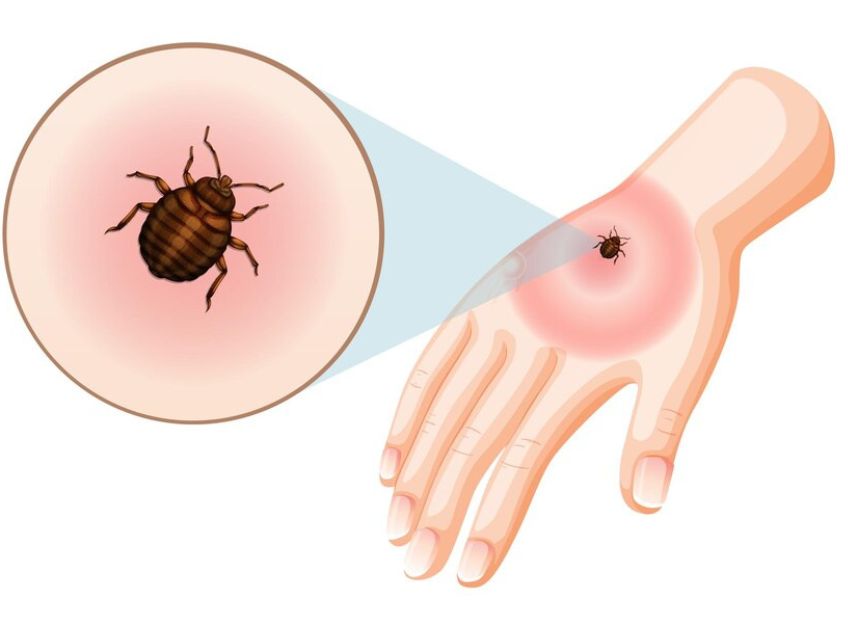 7 Best Home Remedies for Bed Bug Bites That Actually Work