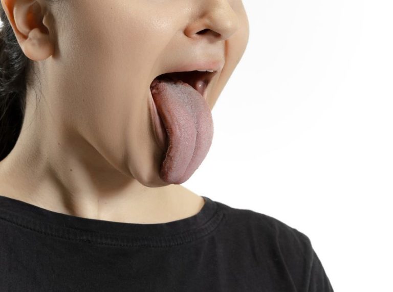 Warts on the Tongue Types, Causes, and Treatments