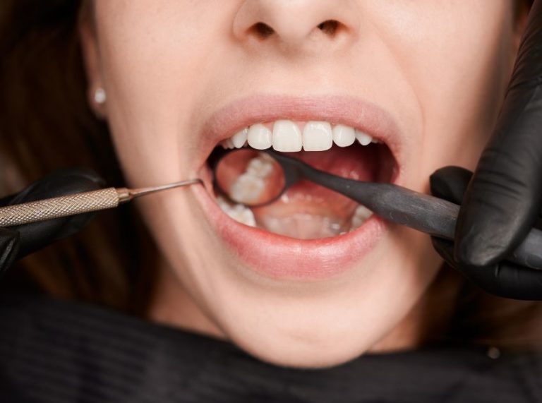 How Long Does A Tooth Cavity Filling Take?