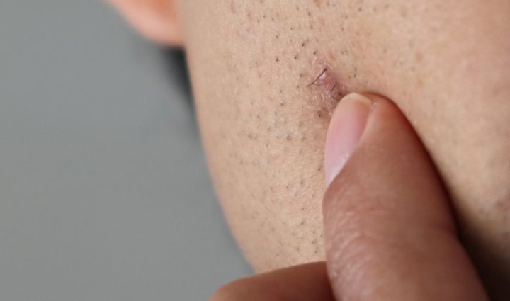 Ingrown Hair 