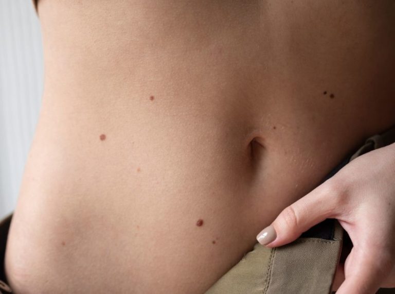 Pimple On Stomach_ Causes, Treatment, And Preventions