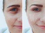 High Cheekbones vs Low Cheekbones Causes & Treatments