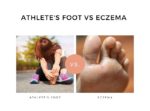 Athlete's foot vs eczema