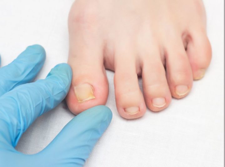 How Long Does It Take For A Toenail To Grow Back
