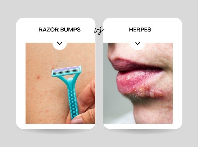 How to Tell If It's Herpes or Razor Bumps Causes, Symptoms and Treatment