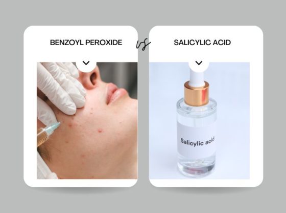 Salicylic Acid Vs Benzoyl Peroxide For Acne: Which Is Best?