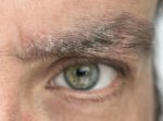 Why Do My Eyebrows Have Dandruff Causes and Treatment