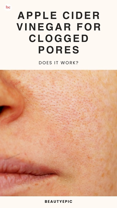 apple cider vinegar for clogged pores