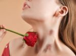 Can Aloe Vera Erase a Hickey Here’s What Skin Experts Say