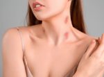 Does Toothpaste Really Get Rid of Hickeys What You Should Know