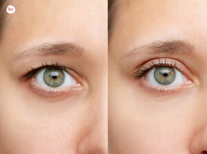 how to fix droopy eyelids naturally