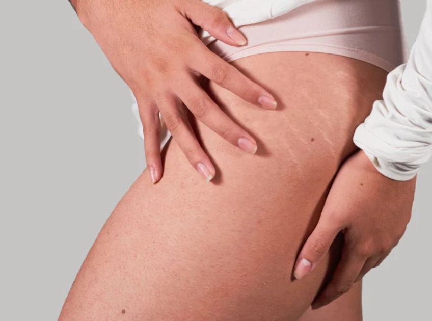 Coconut Oil and Coffee Scrub for Stretch Marks DIY - How does it work