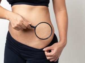 DIY Coconut Oil and Camphor for Stretch Marks - How does it work