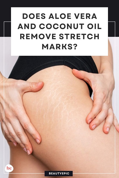 aloe vera and coconut oil for stretch marks