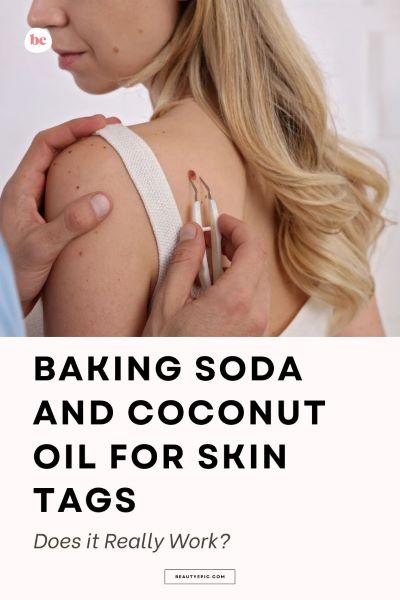 baking soda and coconut oil for skin tags