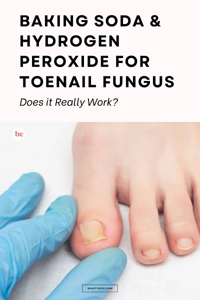 baking soda and peroxide for toenail fungus